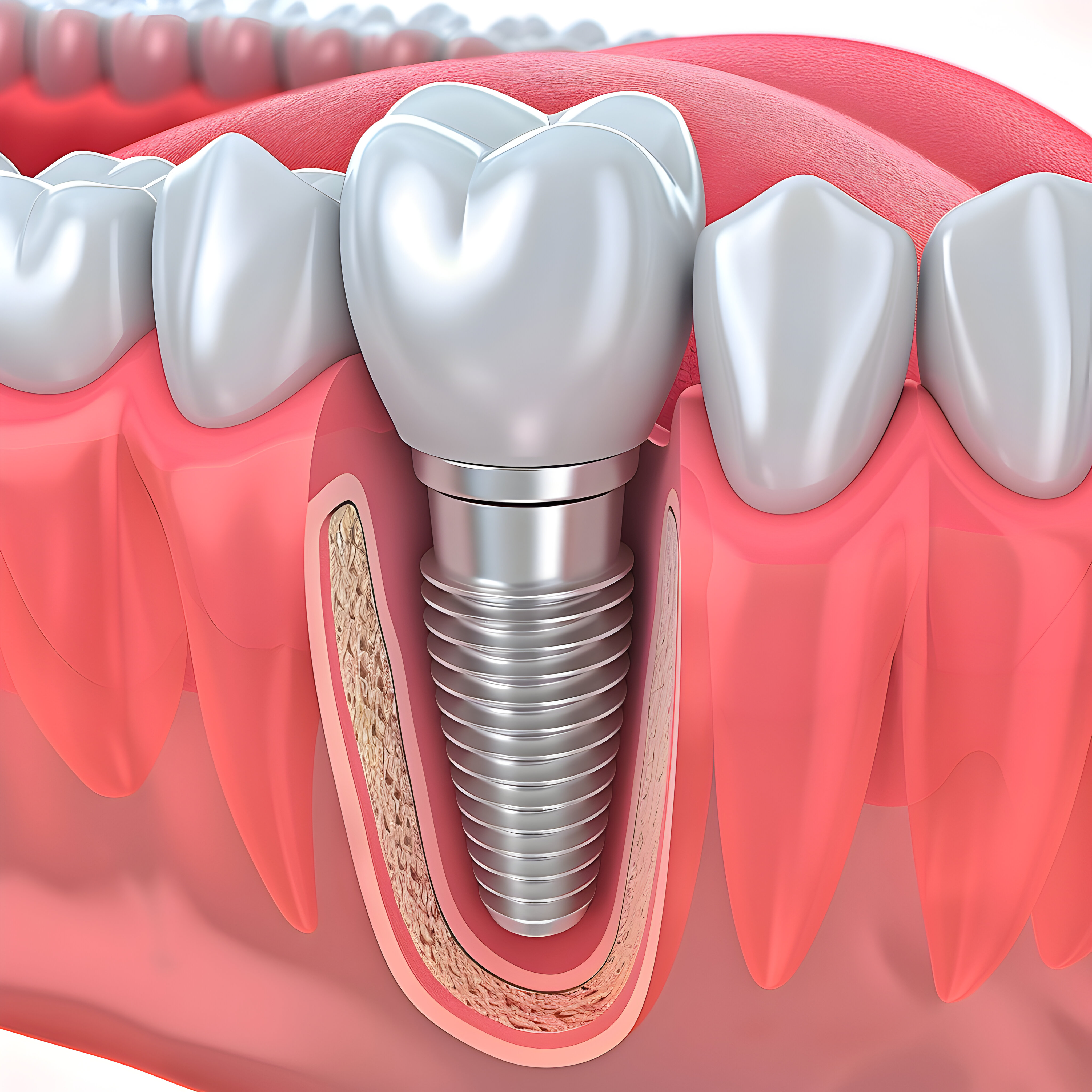 Self-Ligating Braces