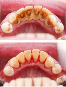 Self-Ligating Braces