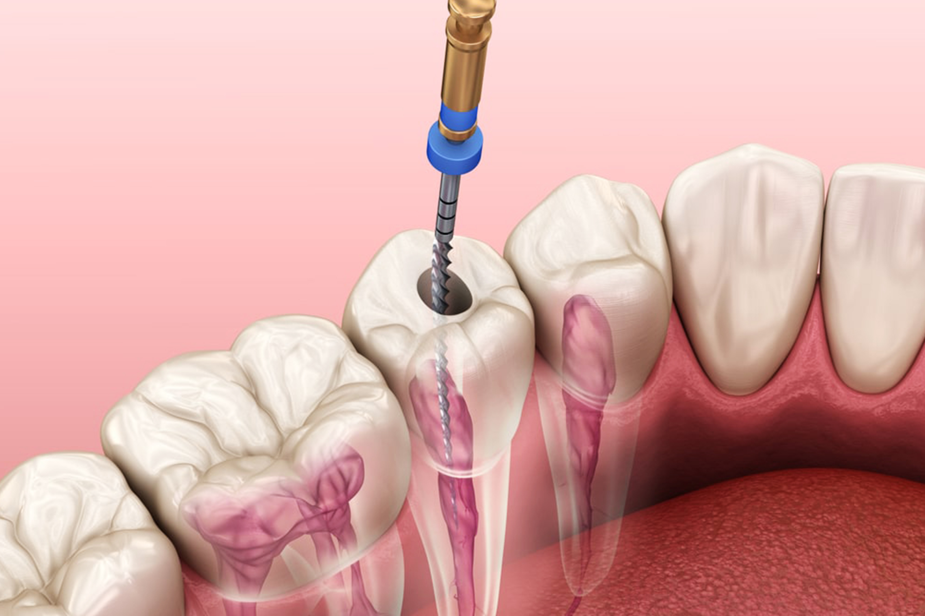 Img Root canal